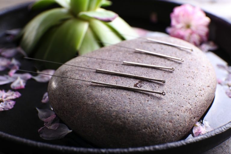 Vaincre le stress par l’acupuncture