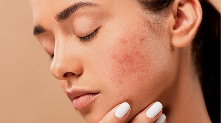 5 conseils de soins de la peau pour réduire les rougeurs de la rosacée